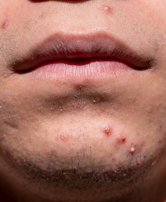 De l'acné au vieillissement : Comment la crème CBD pour la peau peut résoudre vos problèmes de peau - HerBeevor