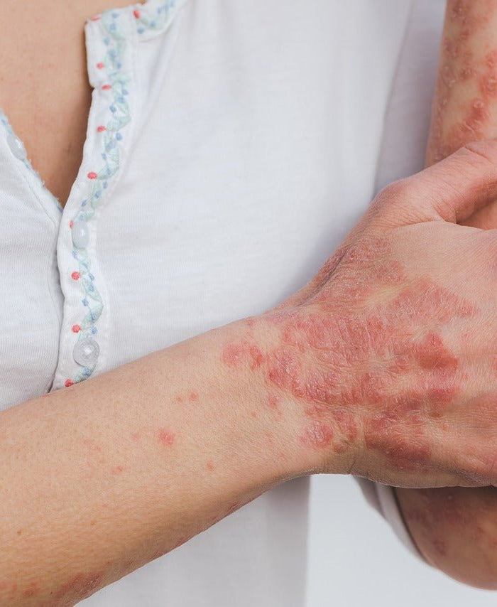 Les avantages du CBD pour les personnes atteintes de maladies de la peau - HerBeevor