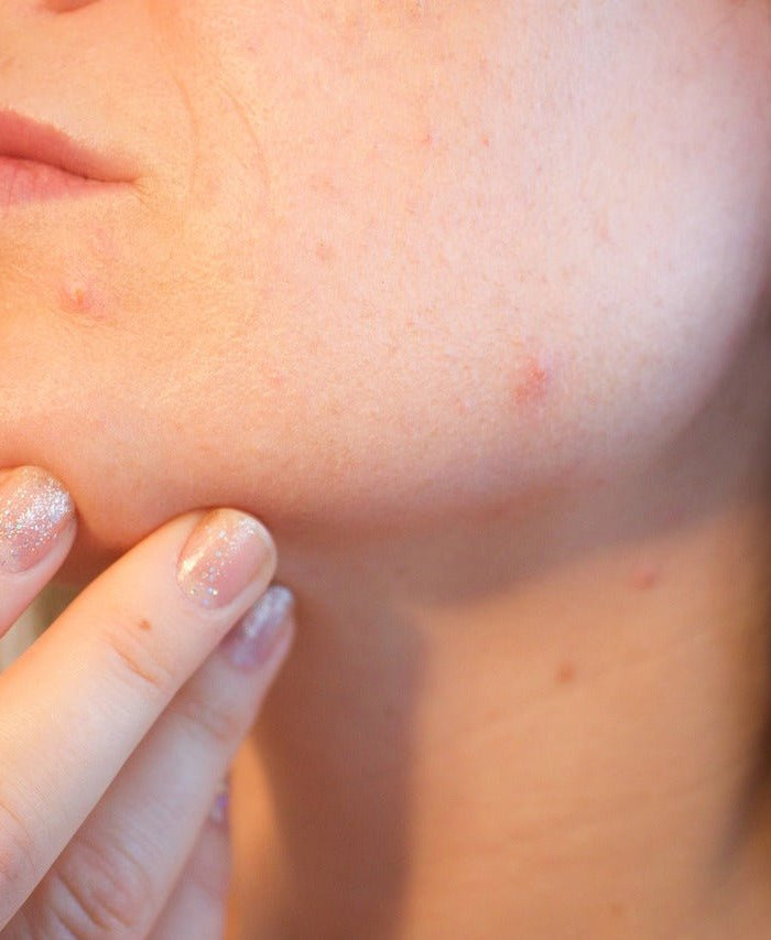 Les effets du CBD sur la peau : traitement de l'acné, du psoriasis, etc... - HerBeevor